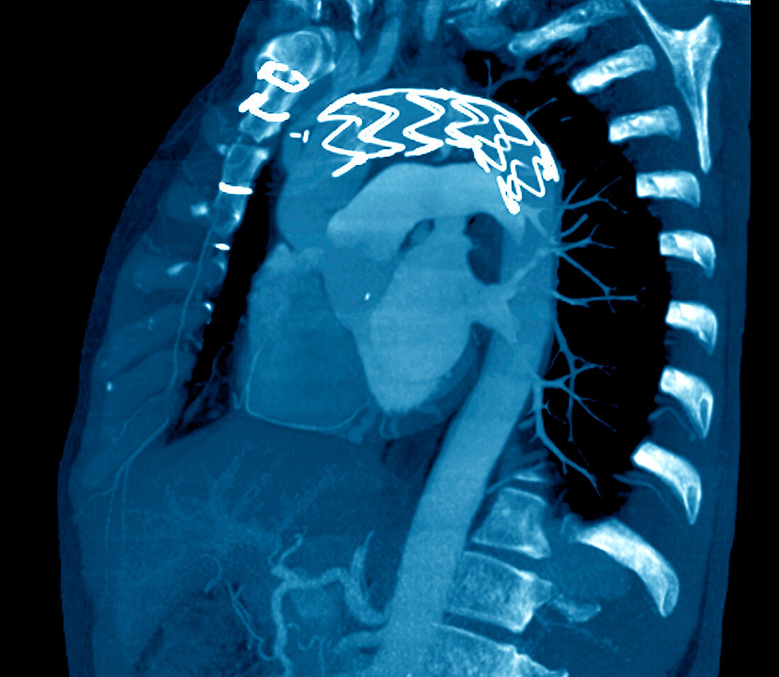 Stent in a dissecting aorta,CT scan