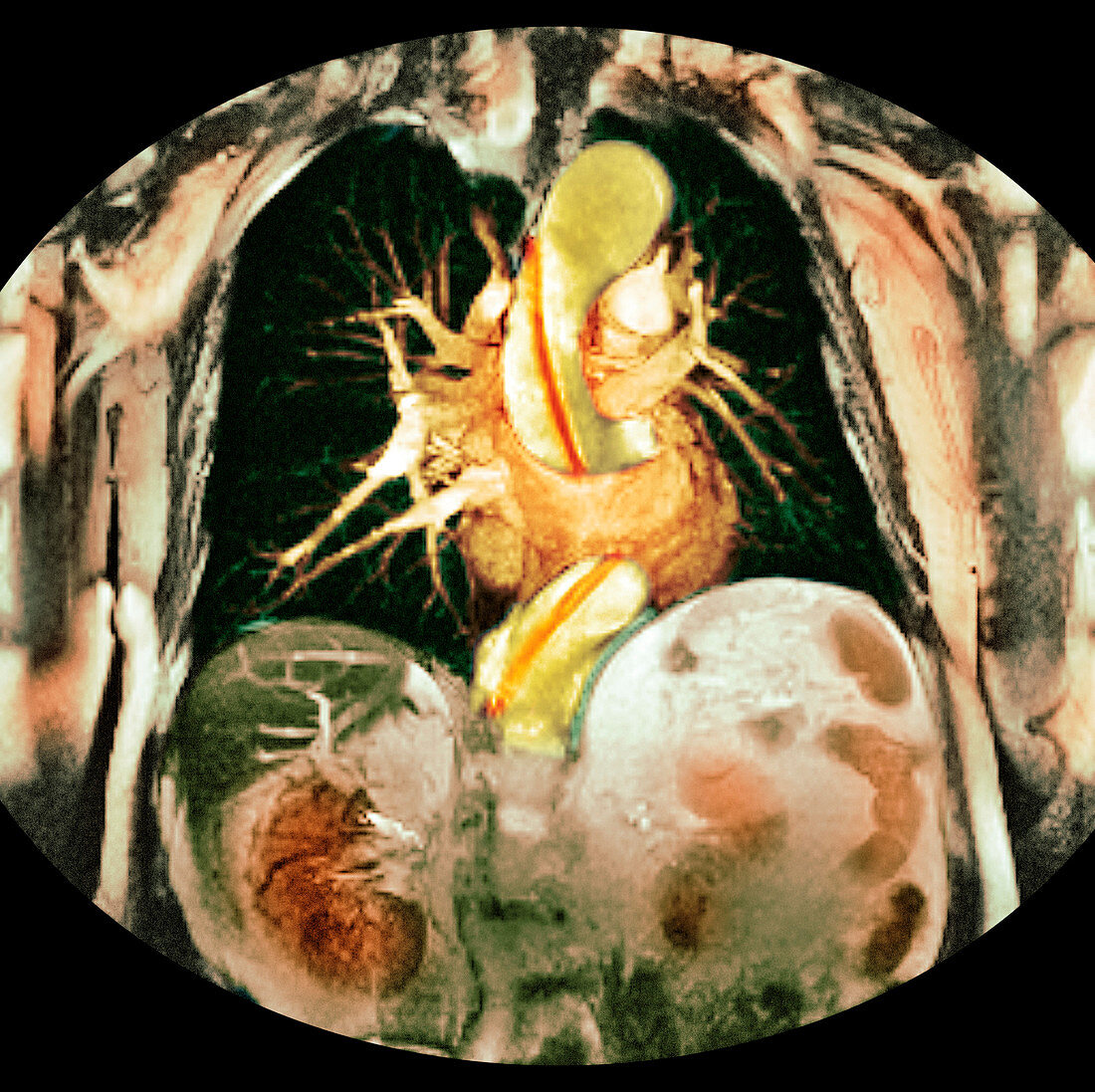 Dissecting aorta,MRI scan