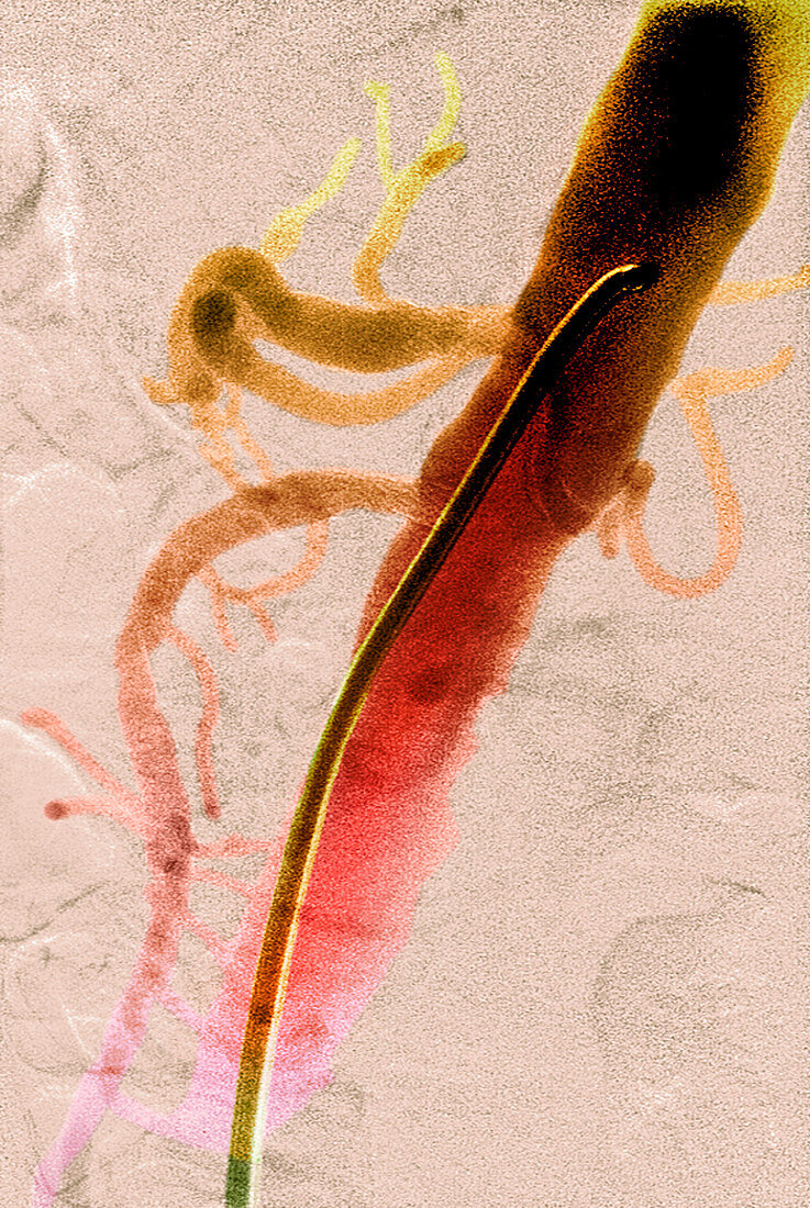 Arterial stents,X-ray