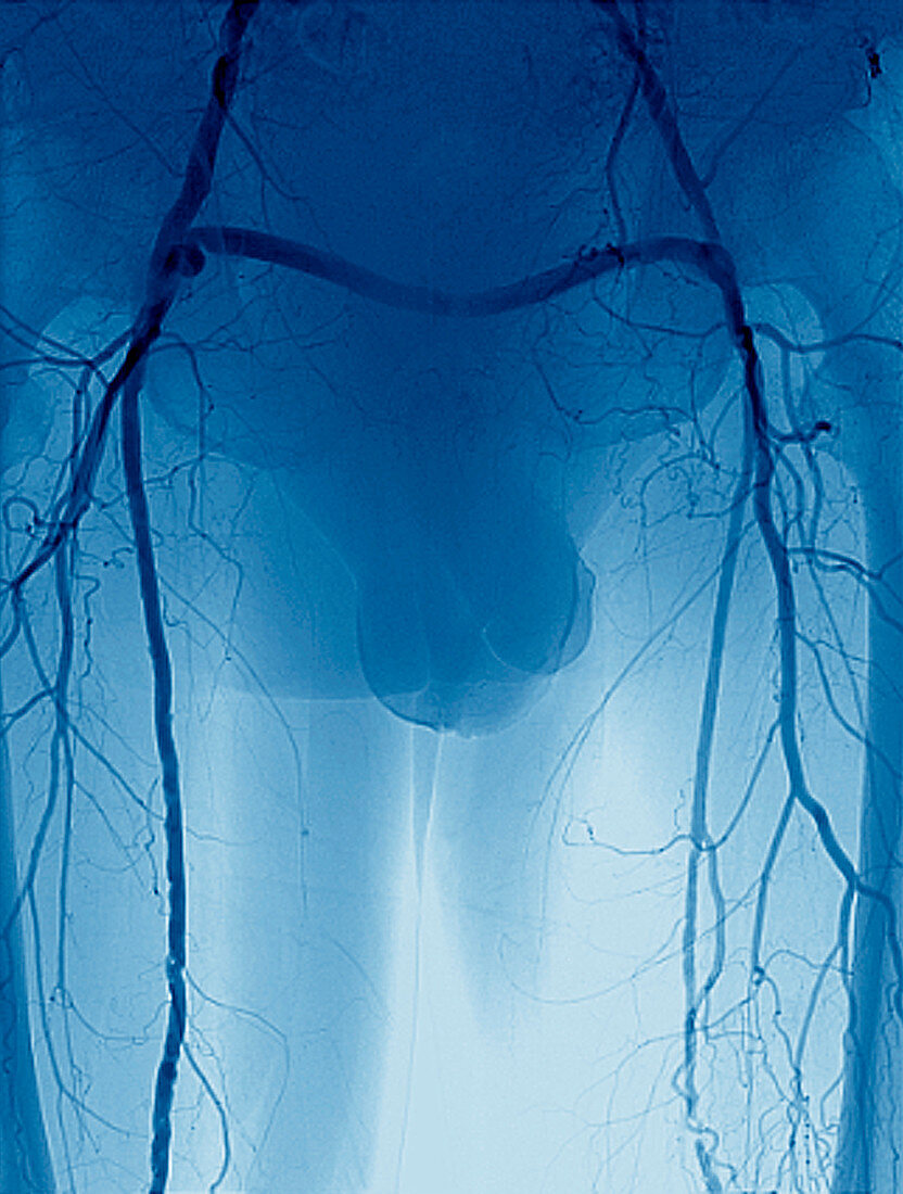 Arterial bypass,angiogram