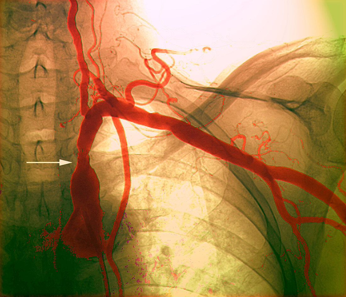 Narrowed subclavian artery,angiogram