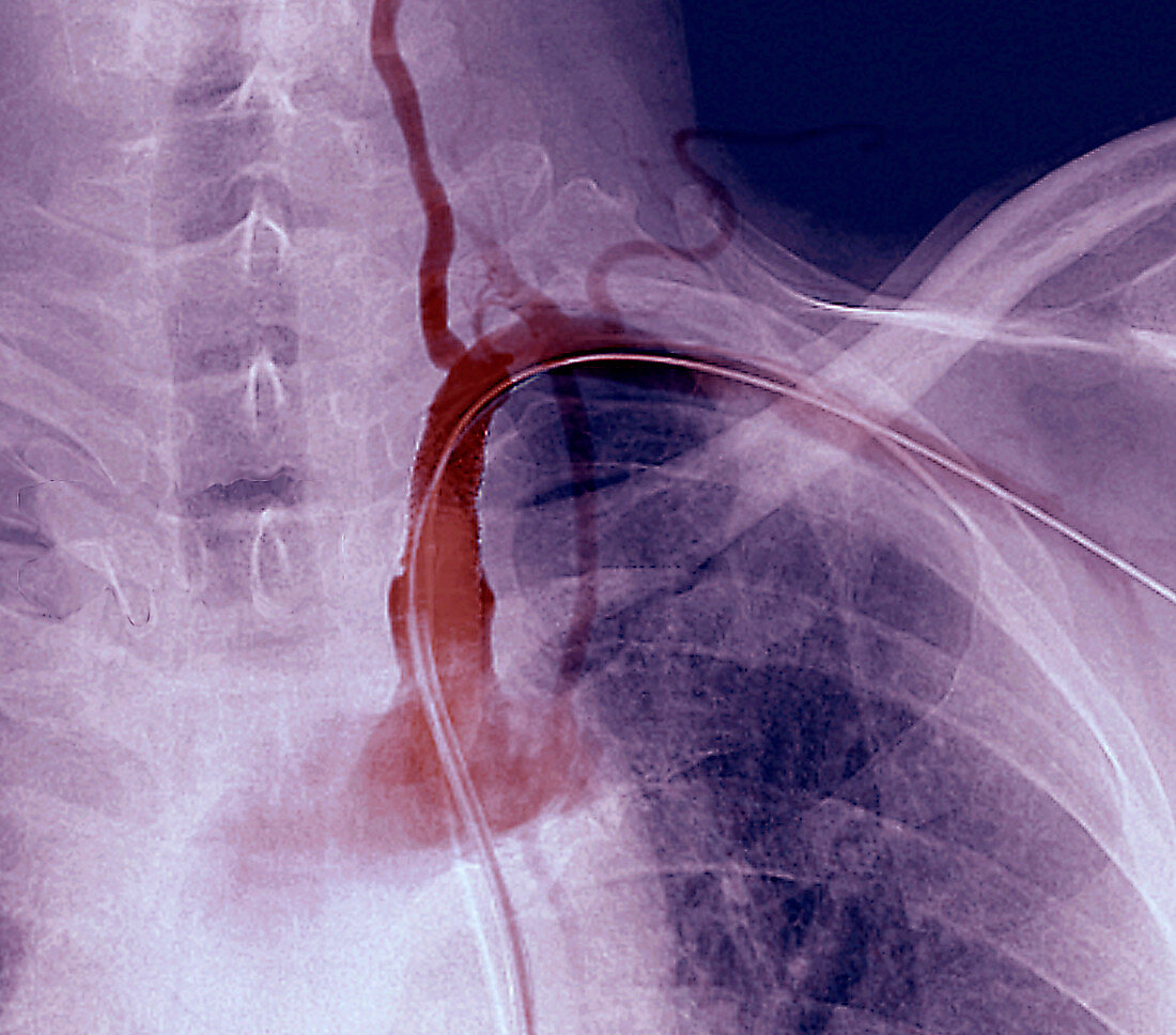 Stent in subclavian artery,angiogram