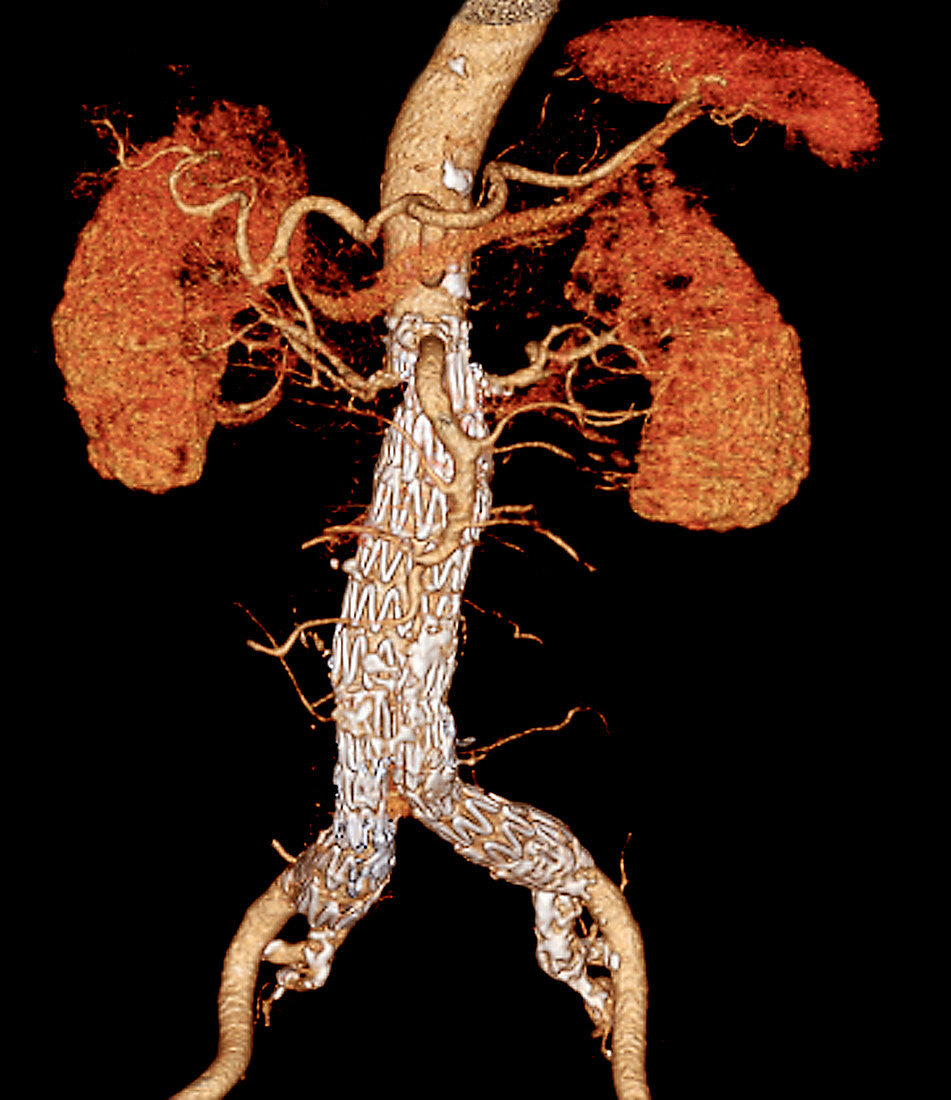 Stent in the abdominal aorta,3D CT scan