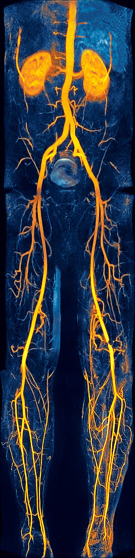 Narrowed leg artery,MRA scan