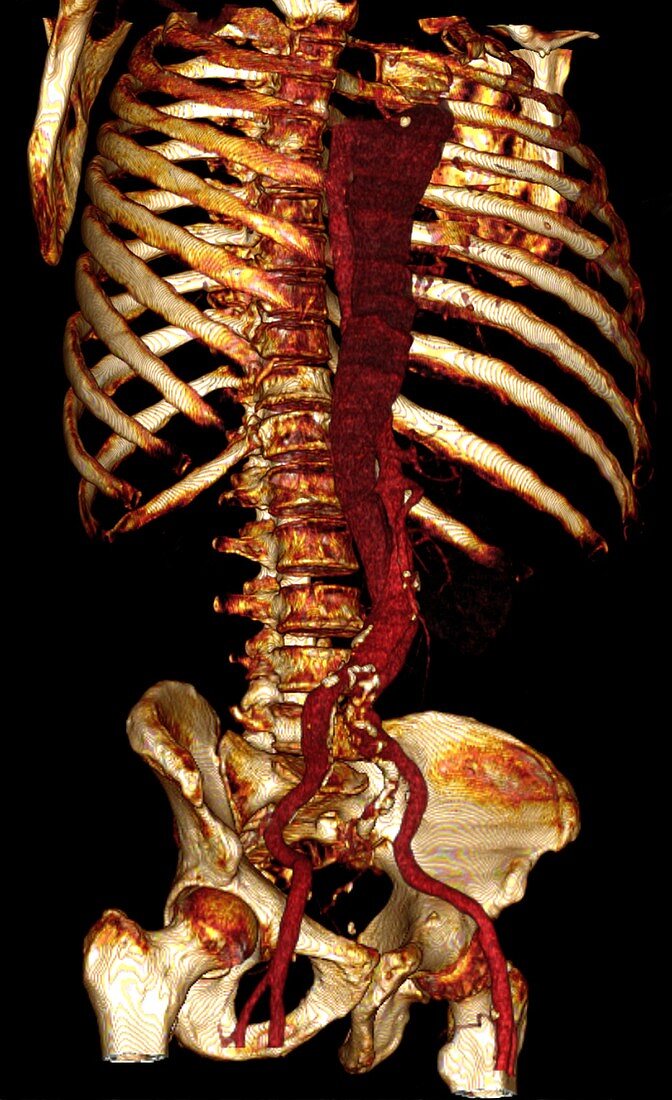 Aortic dissection,3D CT scan