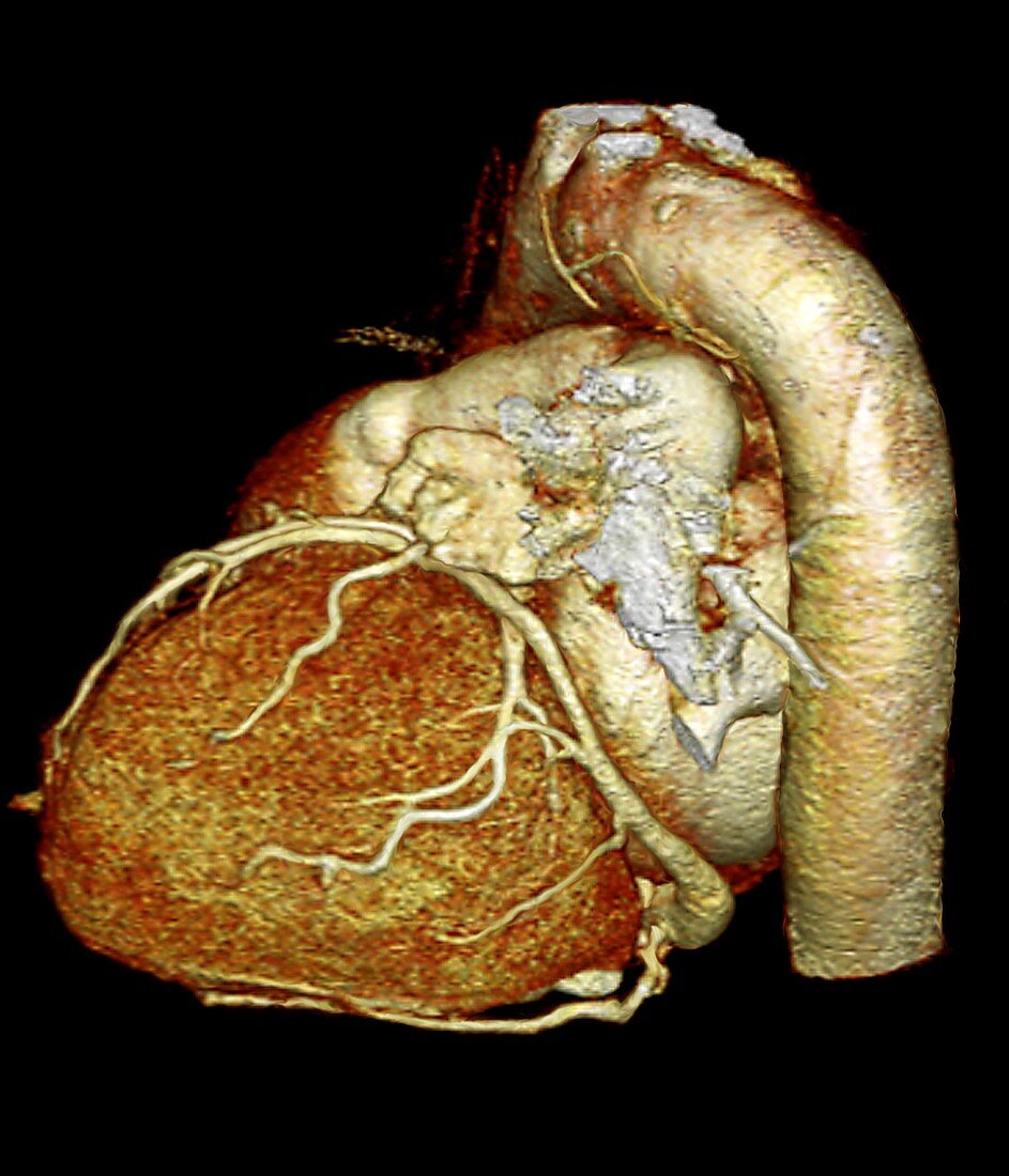 Aortic aneurysm,3D CT scan