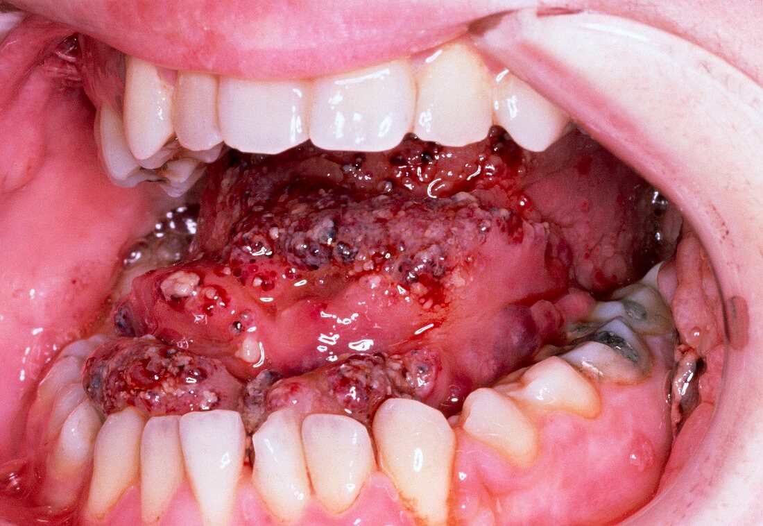 Lymphangioma affecting the tongue