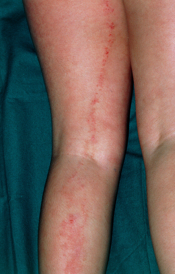 Larva migrans,skin rash due to hookworm larvae
