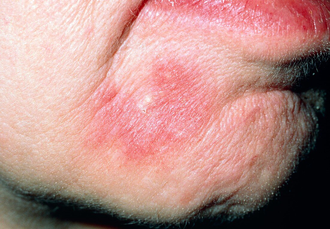 Systemic lupus erythematosis lesion on the face