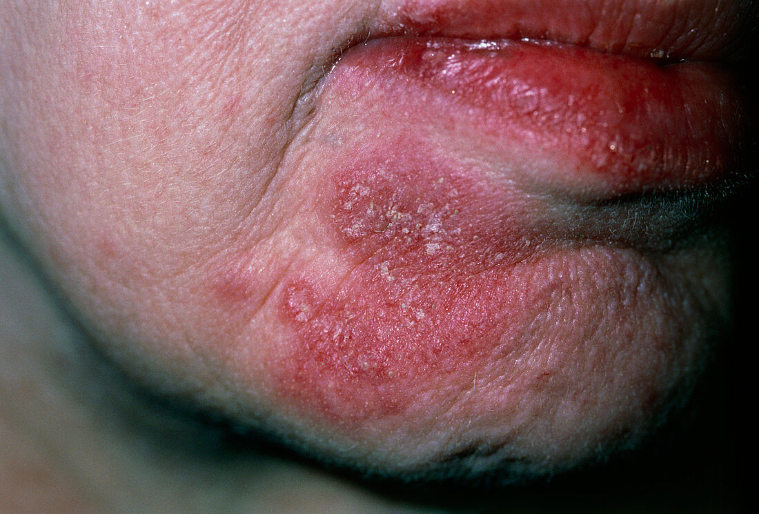 Facial rash of Systemic Lupus Erythematosus (SLE)