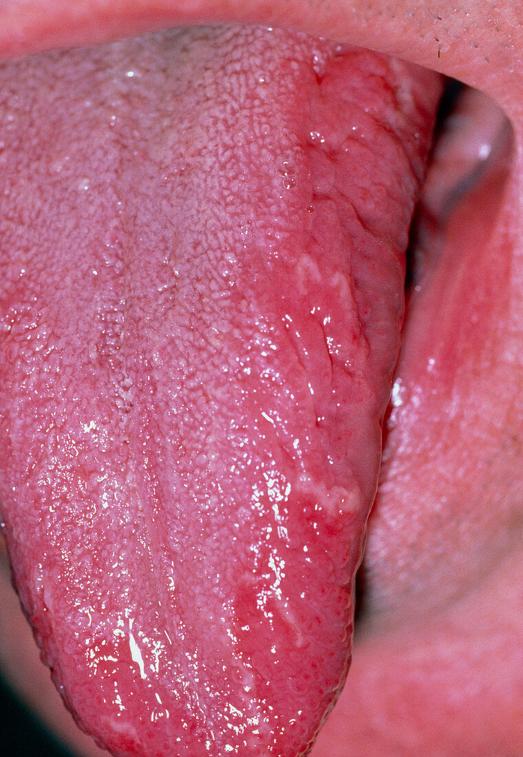 Raised leukoplakia patches on side of tongue