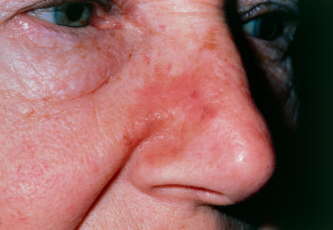 Lentigo on elderly woman's nose due to sun