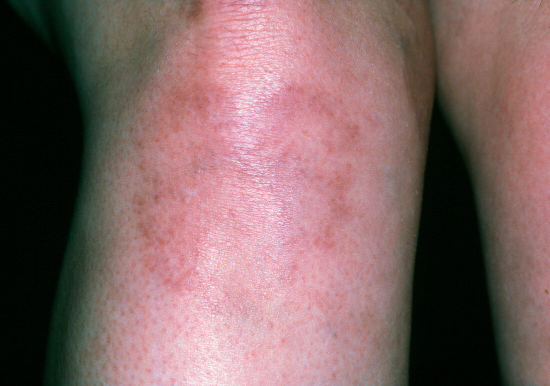 Systemic lupus erythematosus rash on woman's leg