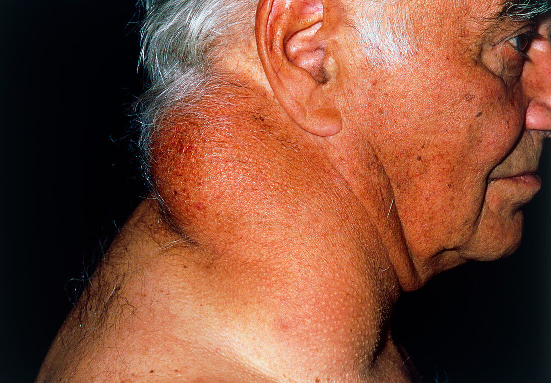 Swollen neck of old man due to lipoma