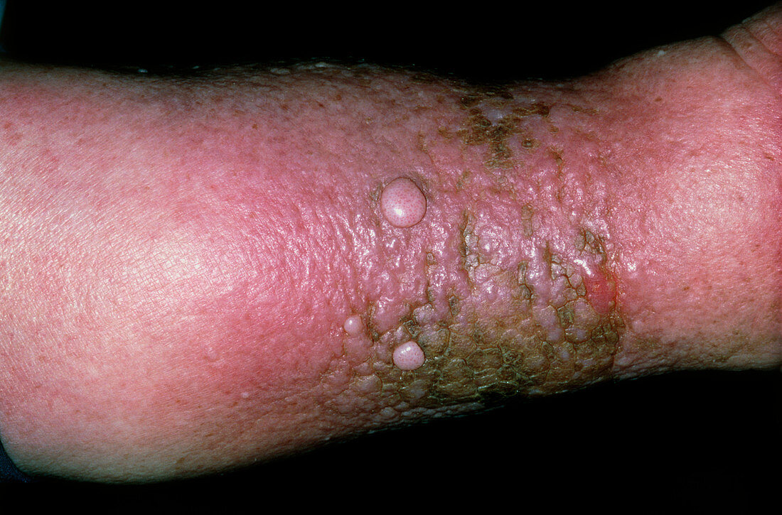Swollen leg of patient with lymphoedema