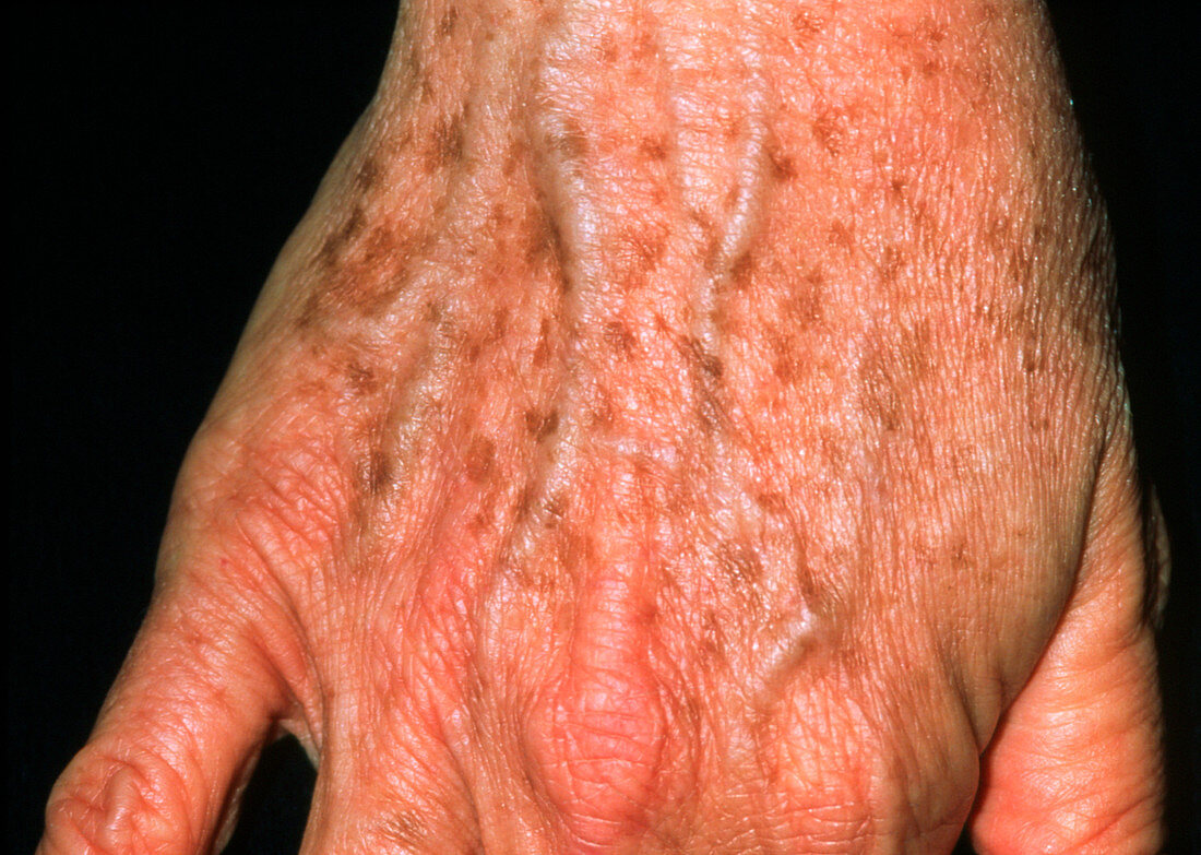 Lentigo: liver spots on a 53-year-old woman's hand