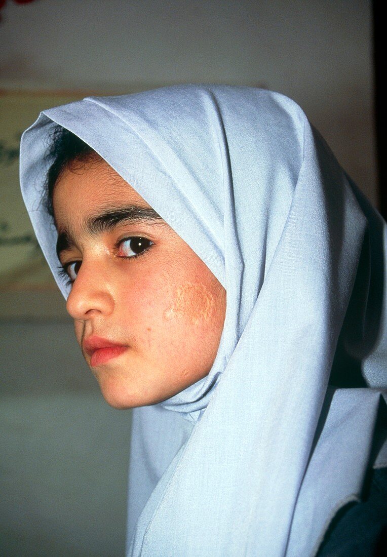Cutaneous leishmaniasis scar on the face of a girl