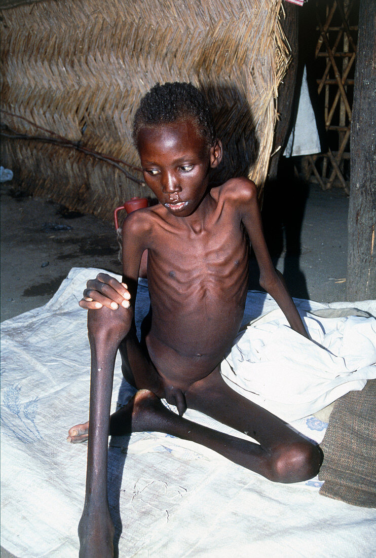 Starving boy suffering from visceral leishmaniasis