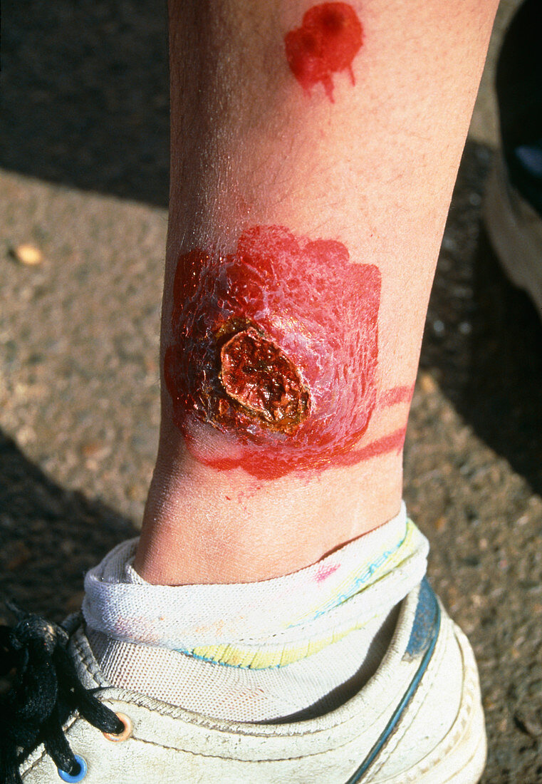 Treated cutaneous leishmaniasis lesion on leg