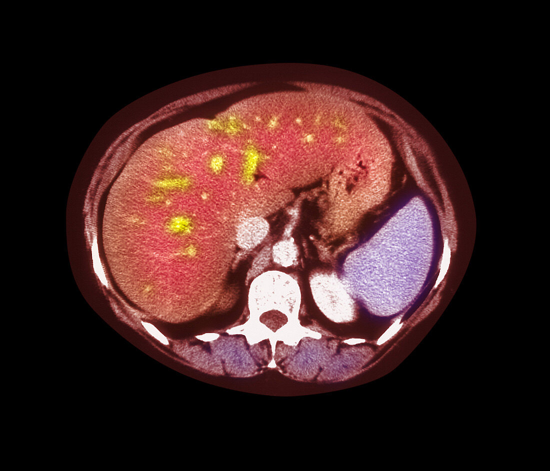 Fatty liver CT scan