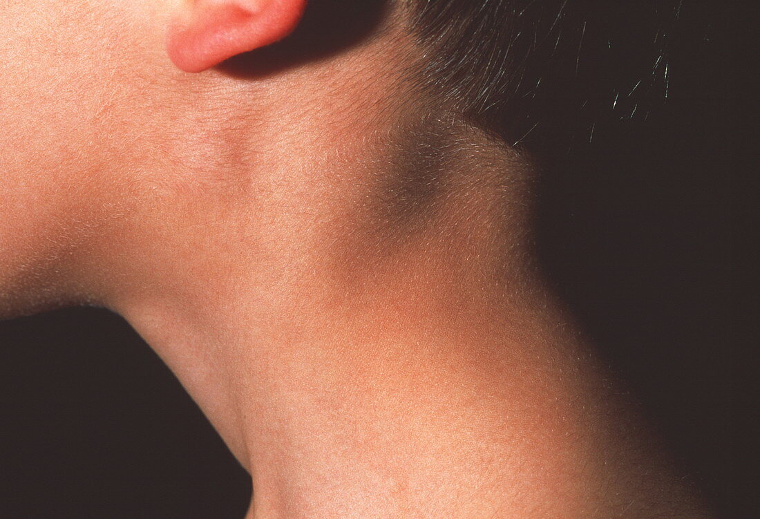 Swollen neck gland