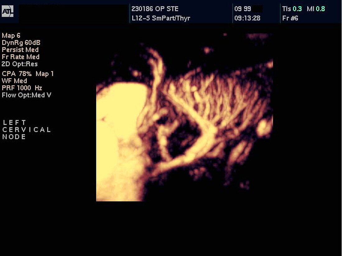 Inflamed lymph node,Doppler ultrasound