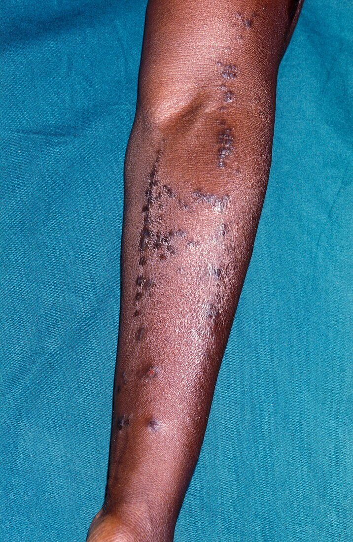 Lichen planus skin disease