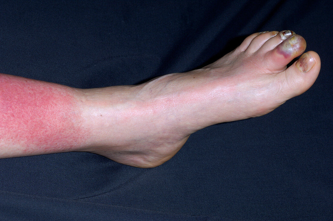 Lymphangitis infection of the leg