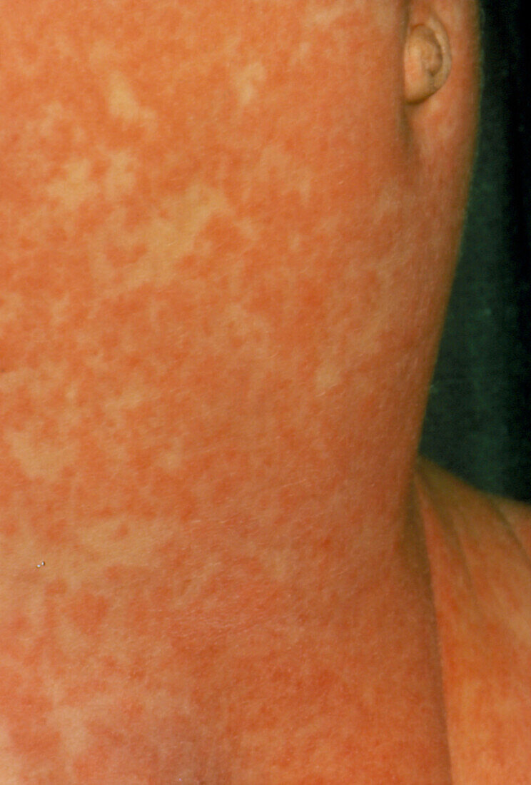 Infant girl covered with measles rash