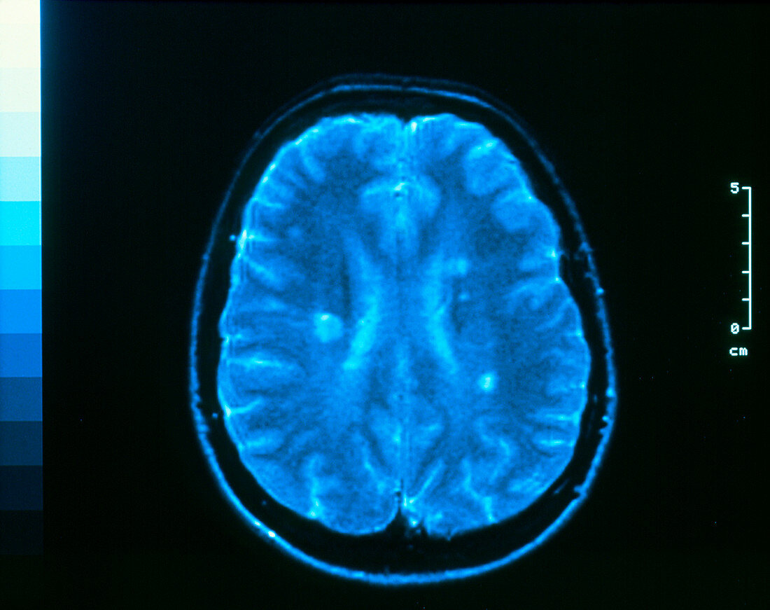 MRI scan of brain in multiple sclerosis