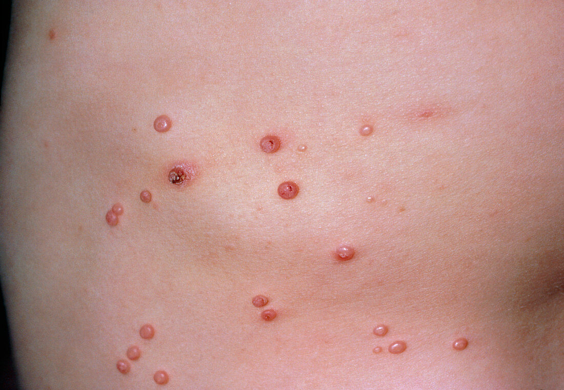 Molluscum contagiosum,pox virus skin infection
