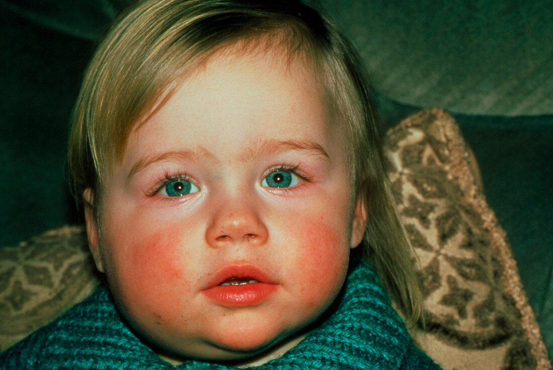 Two year old child affected by mumps