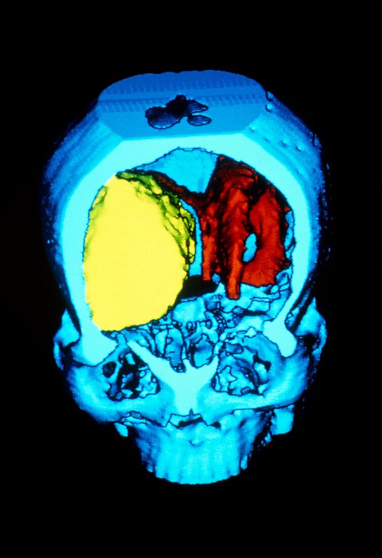 Coloured 3-D CT scan of brain with meningioma
