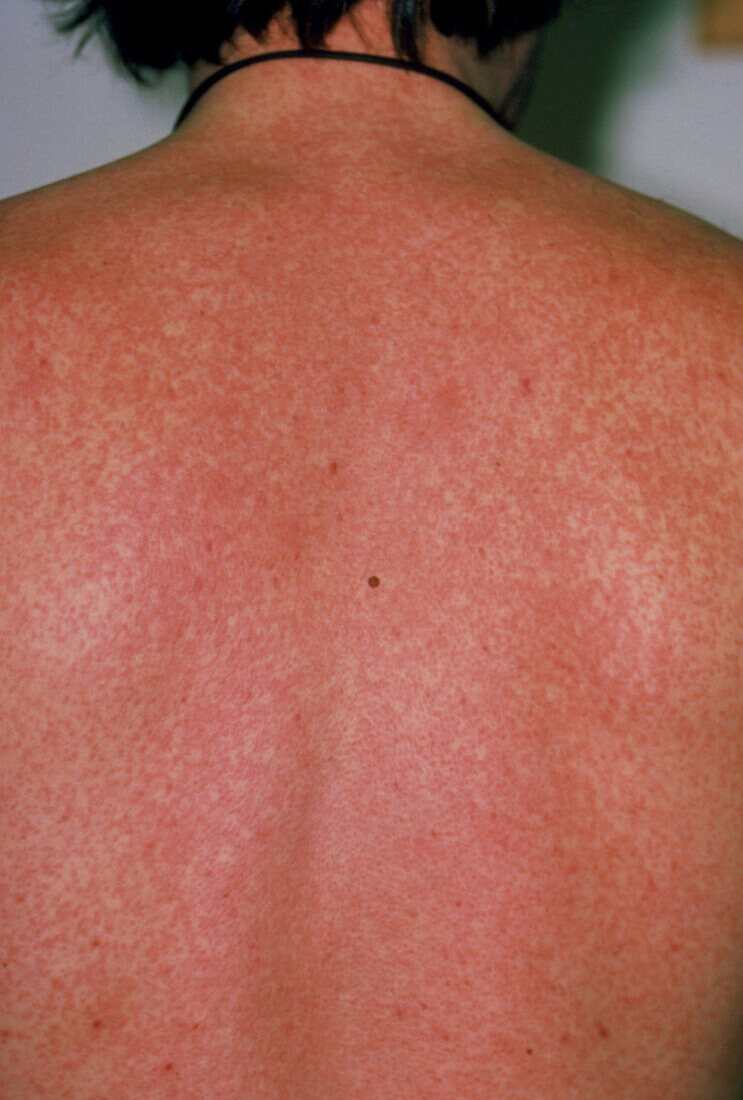 A severe measles rash on the back of a man