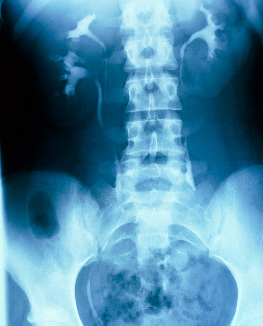 Intravenous pyelogram showing duplex kidney