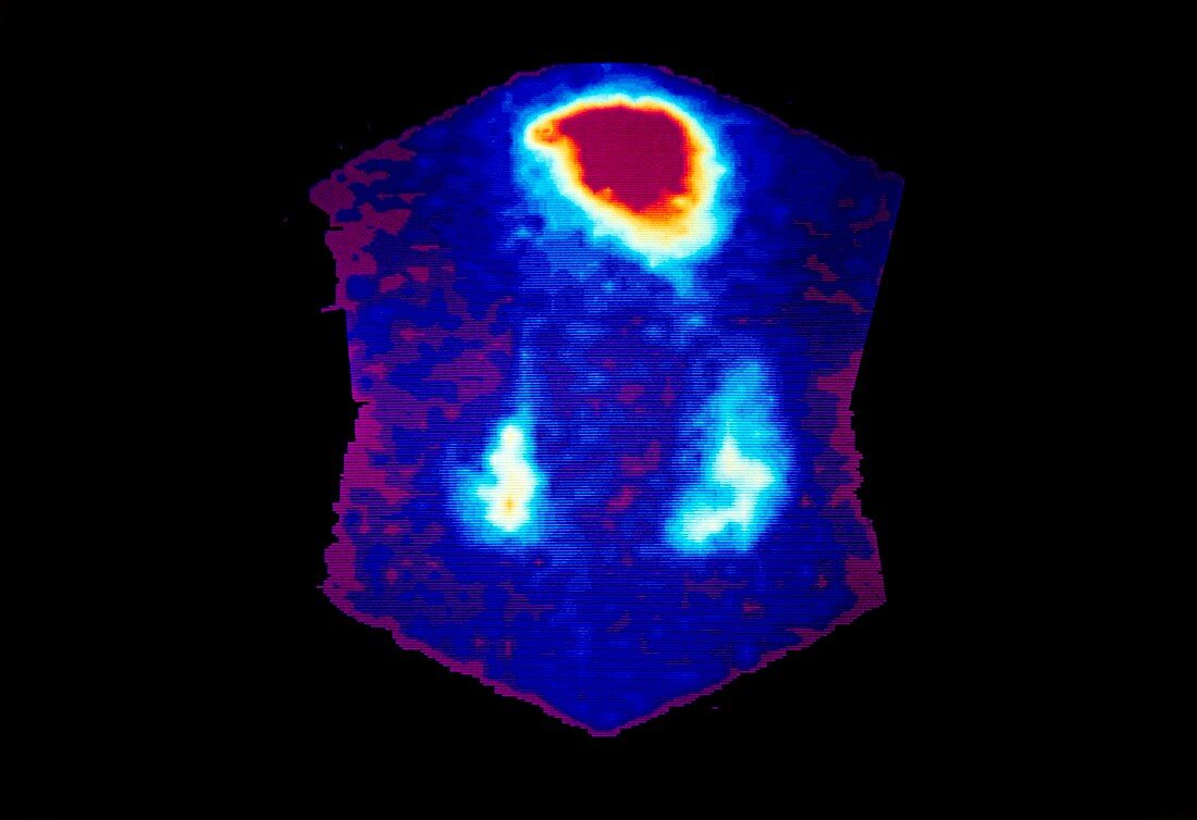 Coloured Gamma Scan showing urine reflux to kidney