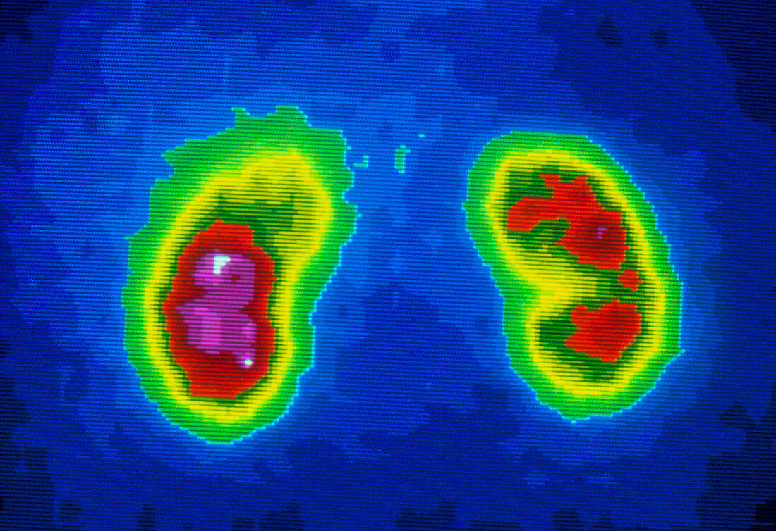 Gamma scan of kidney failure in right kidney