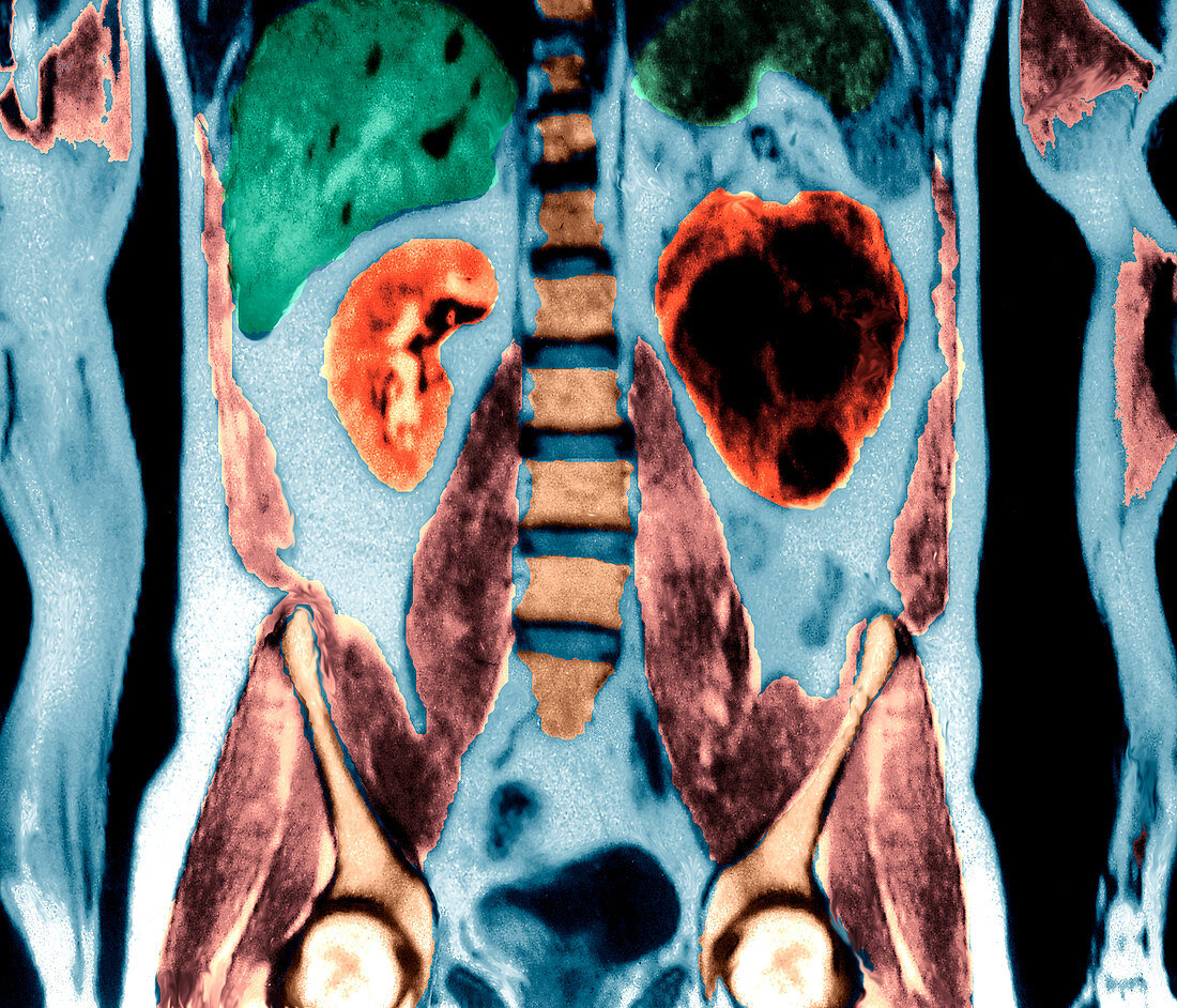 Kidney cysts,abdominal MRI scan