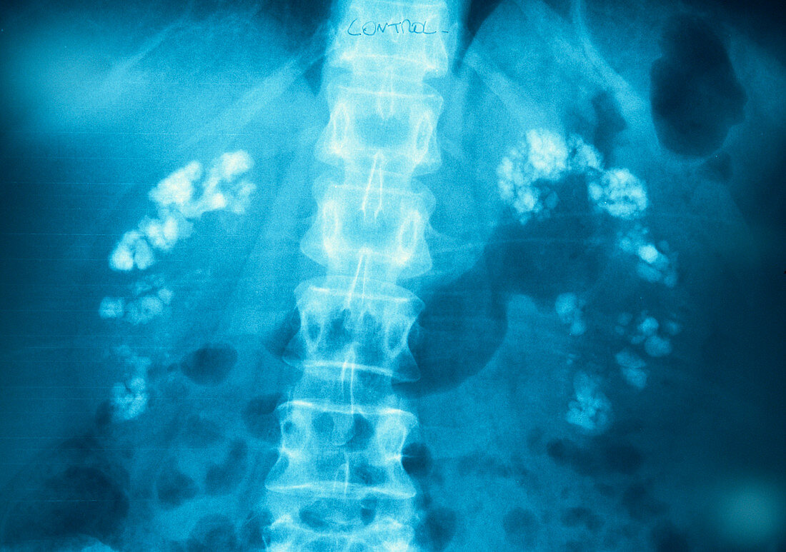 Kidney calcification,X-ray