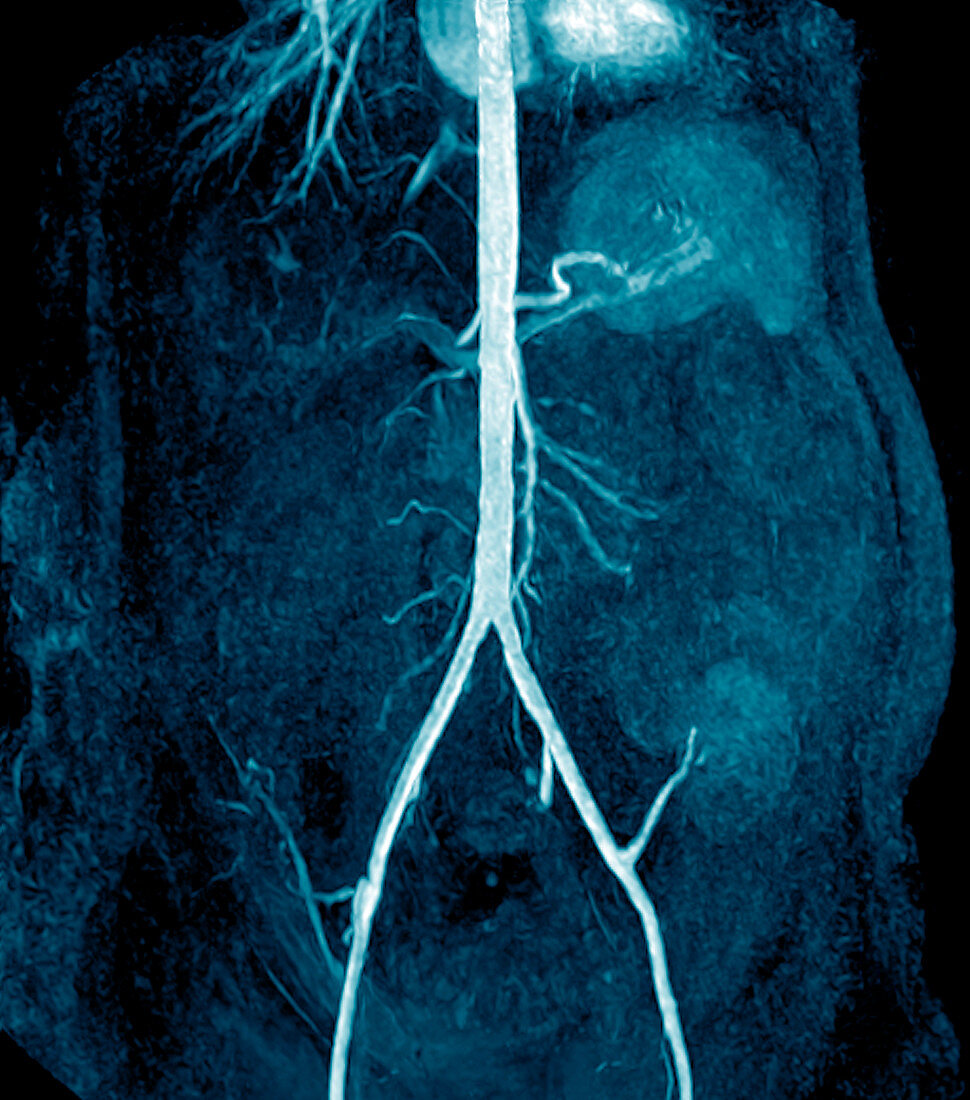 Transplanted kidney,MRI scan