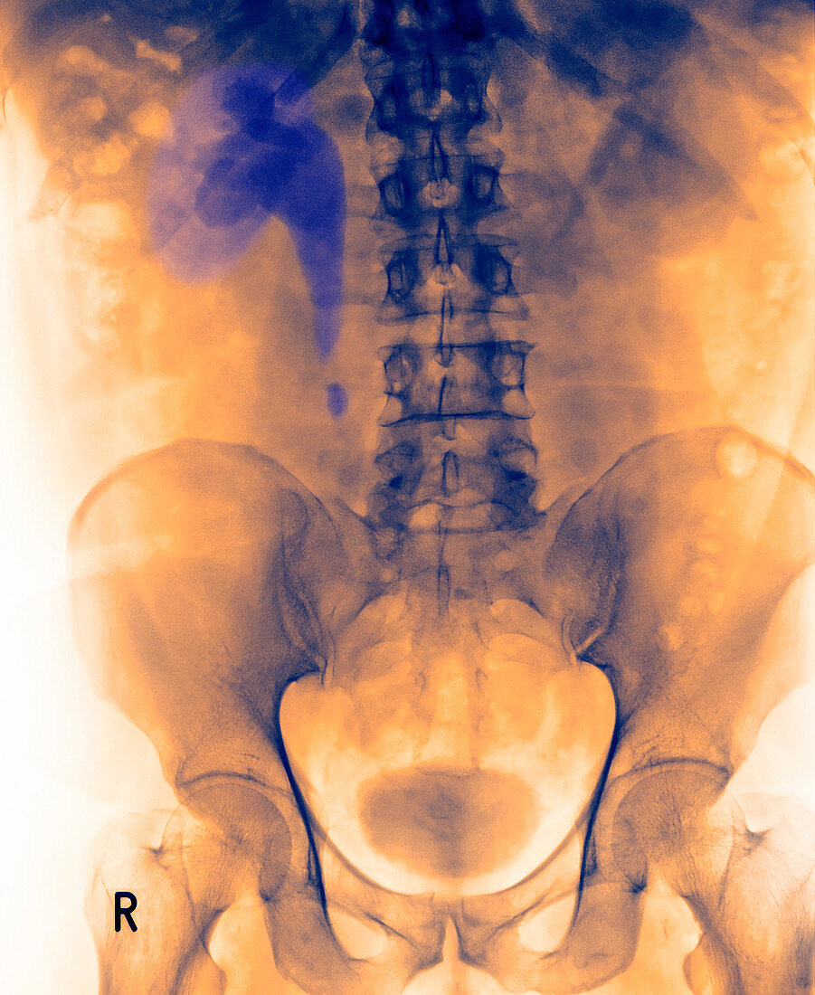 Kidney stone,X-ray