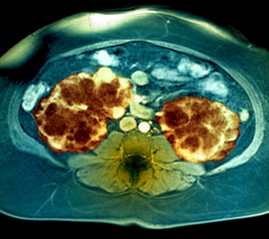 Polycystic kidneys,MRI scan