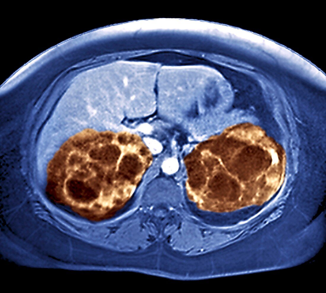Polycystic kidneys,MRI scan
