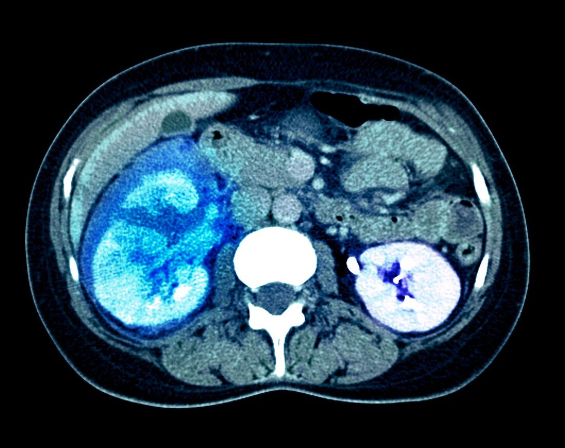 Kidney damage,CT scan