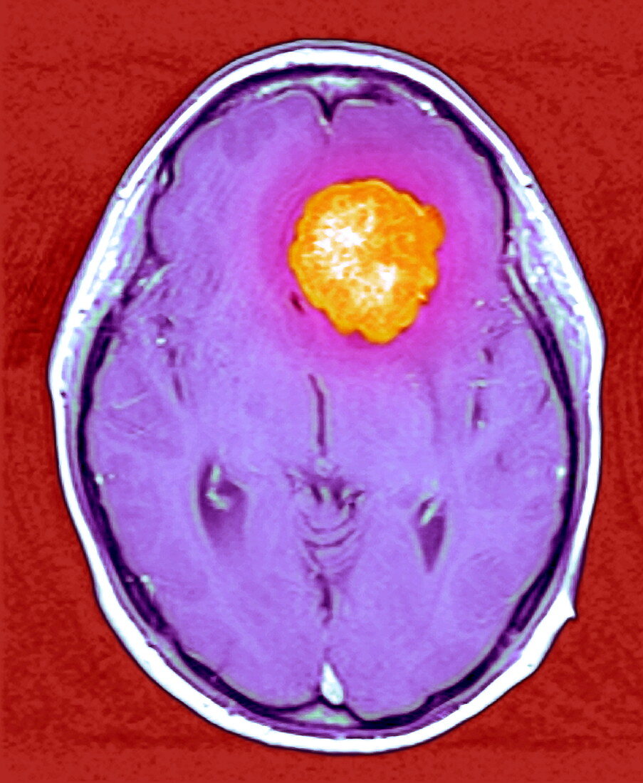 Brain tumour,MRI scan