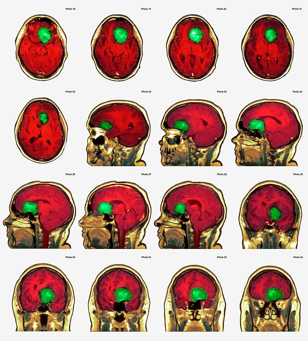 Brain tumour,MRI scans