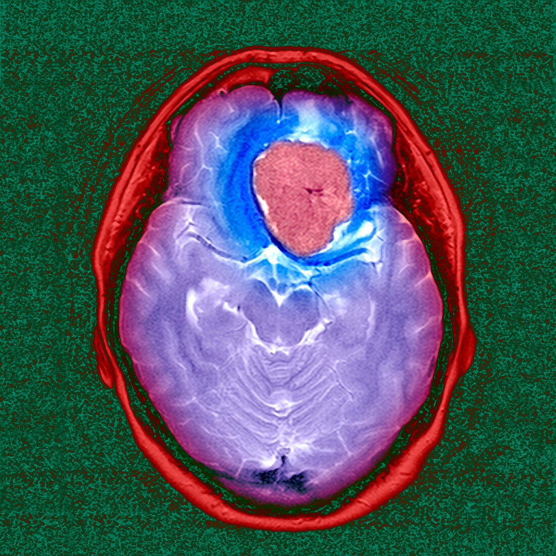 Brain tumour,MRI scan