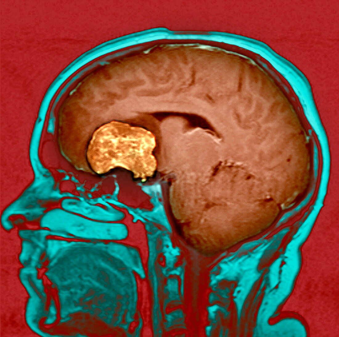 Brain tumour,MRI scan