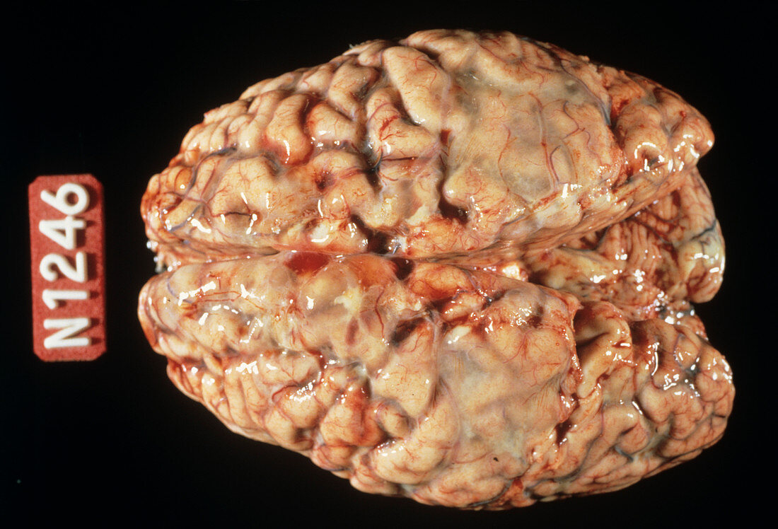 Brain with meningitis