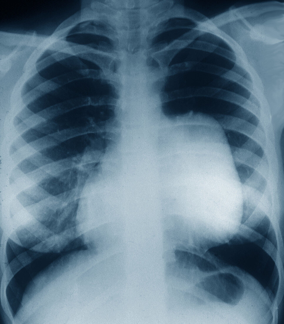 Chest tumour,X-ray